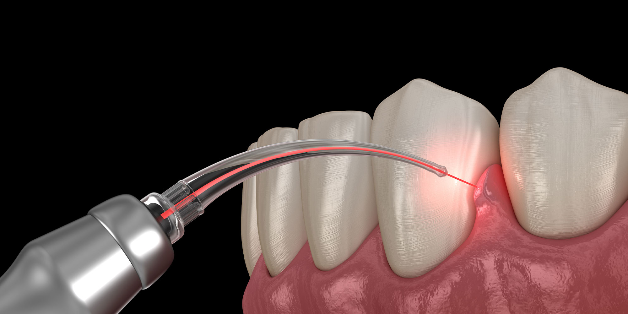 Gum correction surgery with laser. Medically accurate tooth 3D illustration