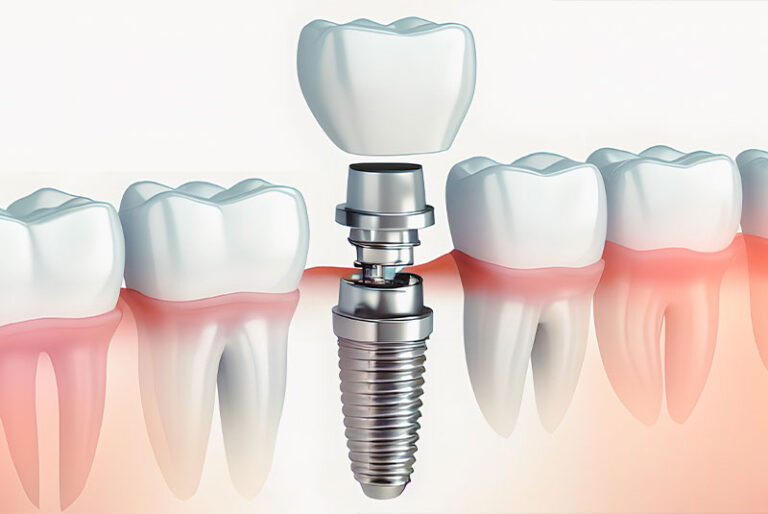 close up of dental implant model illustration