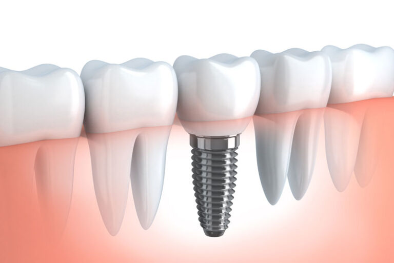 dental implants.
