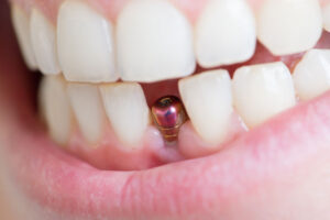 dental implant in mouth.