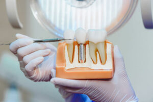 Dental implant model showing tooth crown placement.