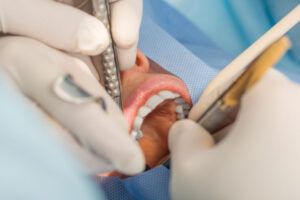 Close-up of a dental procedure with tools in use, highlighting professional oral care in a sterile setting.