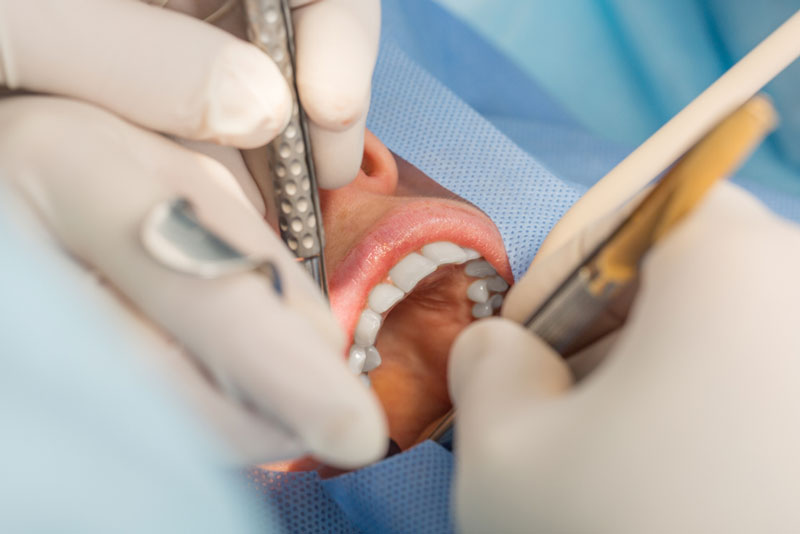 Close-up of a dental procedure with tools in use, highlighting professional oral care in a sterile setting.