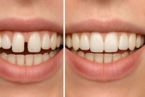 A before and after image of a patient who has had a single dental implant placed to fix a missing tooth. The before image should show a visible gap where the tooth is missing, and the after image should show a natural-looking implant in its place. No text on the image.